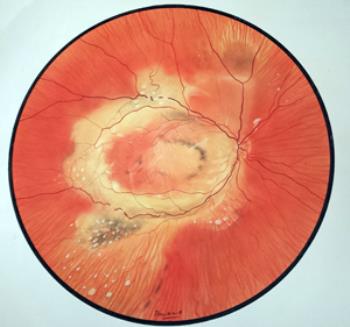 Disceform degeneration macula